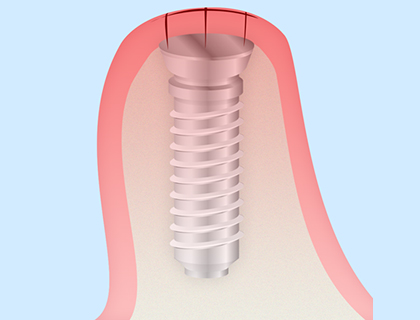STEP4 一次手術