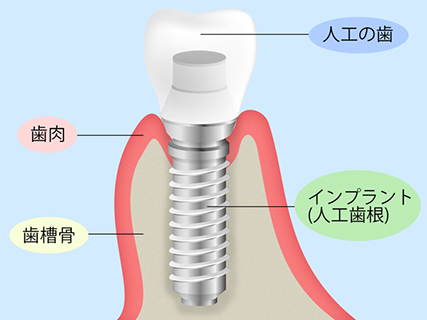 インプラント治療の正しい知識を身に付けましょう